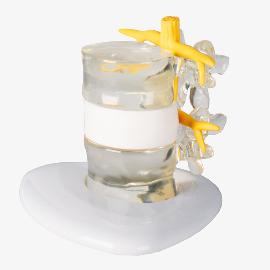 Bandscheibenvorfall-Simulator