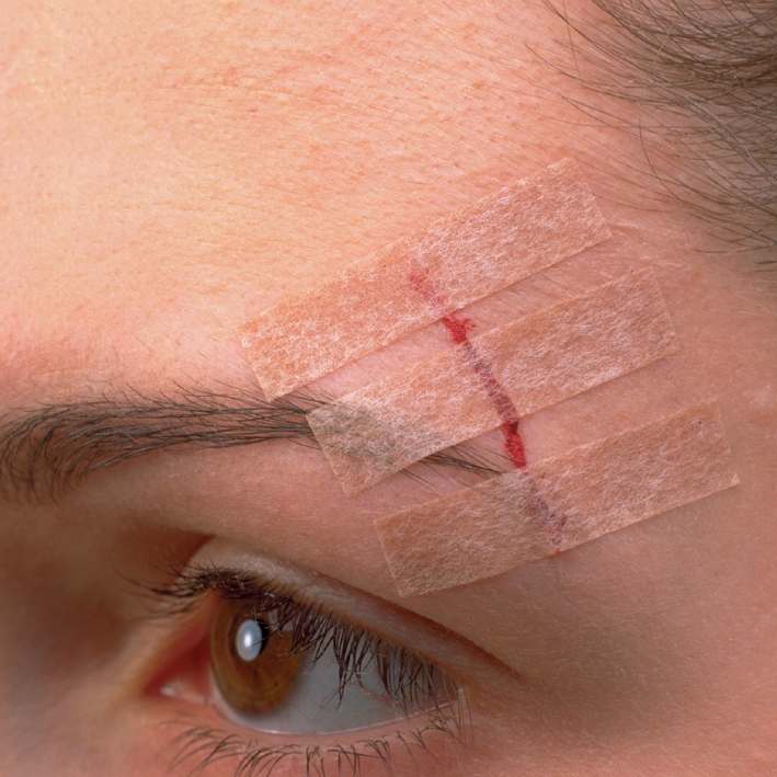 3M Steri-Strip Blendtone 12 x 100 mm,