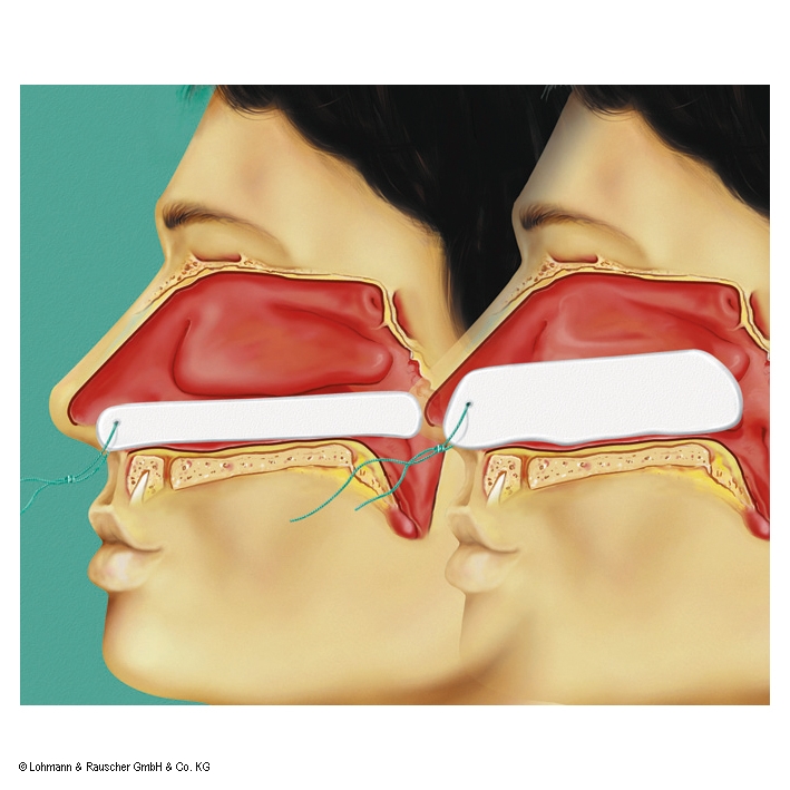 Raucocel-Epistaxistamponaden