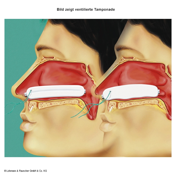 Raucocel Nasentamponaden gerade,